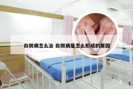 白斑病怎么冶 白斑病是怎么形成的原因