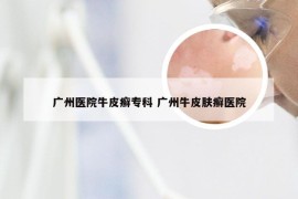 广州医院牛皮癣专科 广州牛皮肤癣医院