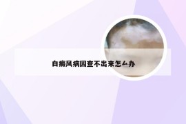 白癜风病因查不出来怎厶办