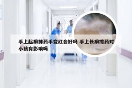 手上起癣抹药手变红会好吗 手上长癣擦药对小孩有影响吗