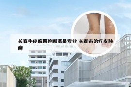 长春牛皮癣医院哪家最专业 长春市治疗皮肤癣