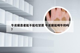 牛皮廨患者能不能吃甘蔗 牛皮廨能喝牛奶吗?