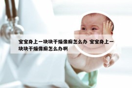 宝宝身上一块块干燥像癣怎么办 宝宝身上一块块干燥像癣怎么办啊