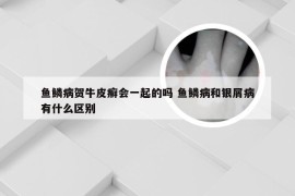 鱼鳞病贺牛皮癣会一起的吗 鱼鳞病和银屑病有什么区别