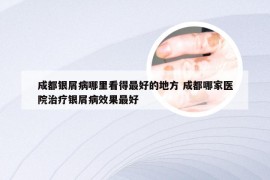 成都银屑病哪里看得最好的地方 成都哪家医院治疗银屑病效果最好