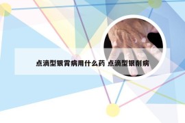 点滴型银霄病用什么药 点滴型银削病