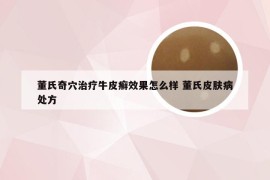 董氏奇穴治疗牛皮癣效果怎么样 董氏皮肤病处方