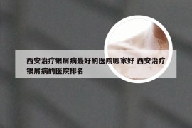 西安治疗银屑病最好的医院哪家好 西安治疗银屑病的医院排名