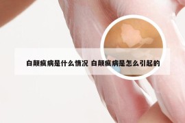 白颠疯病是什么情况 白颠疯病是怎么引起的