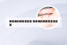 银屑病的鳞屑易脱落 银屑病的鳞屑很容易脱落