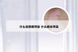 什么皮肤癣传染 什么癣会传染