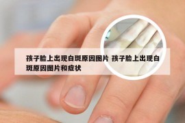 孩子脸上出现白斑原因图片 孩子脸上出现白斑原因图片和症状