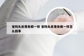 宝妈头皮像有癣一样 宝妈头皮像有癣一样怎么回事