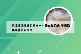 手指没瘙痒感的癣市一中什么样的选 手癣没有真菌怎么治疗