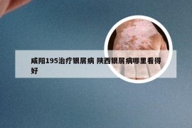 咸阳195治疗银屑病 陕西银屑病哪里看得好