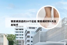 银屑病消退的10个征兆 银屑病好转6大征兆知乎