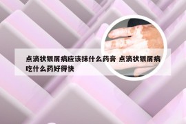 点滴状银屑病应该抹什么药膏 点滴状银屑病吃什么药好得快