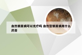 血热银屑病可以光疗吗 血热型银屑病用什么药膏