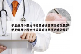 手足癣用中医治疗效果好还西医治疗效果好 手足癣用中医治疗效果好还西医治疗效果好