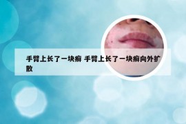 手臂上长了一块癣 手臂上长了一块癣向外扩散