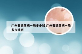 广州看银屑病一般多少钱 广州看银屑病一般多少钱啊