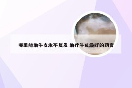 哪里能治牛皮永不复发 治疗牛皮最好的药膏