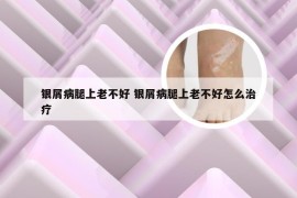 银屑病腿上老不好 银屑病腿上老不好怎么治疗