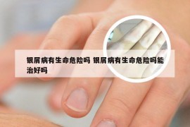 银屑病有生命危险吗 银屑病有生命危险吗能治好吗