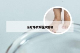 治疗牛皮癣医院排名