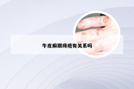 牛皮癣跟痔疮有关系吗