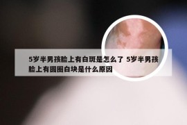 5岁半男孩脸上有白斑是怎么了 5岁半男孩脸上有圆圈白块是什么原因