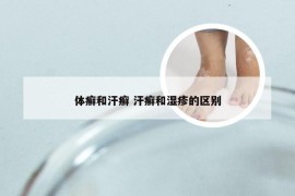 体癣和汗癣 汗癣和湿疹的区别