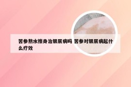 苦参熬水擦身治银屑病吗 苦参对银屑病起什么疗效