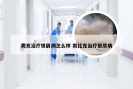 类克治疗银屑病怎么样 类比克治疗银屑病