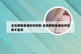 急性期银屑病如何控制 急性期银屑病如何控制不复发