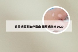 银屑病国家治疗指南 银屑病指南2020