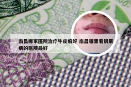 南昌哪家医院治疗牛皮癣好 南昌哪里看银屑病的医院最好