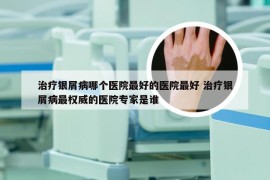 治疗银屑病哪个医院最好的医院最好 治疗银屑病最权威的医院专家是谁