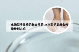 水泡型手足癣的联合用药 水泡型手足癣会传染给别人吗