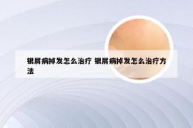 银屑病掉发怎么治疗 银屑病掉发怎么治疗方法