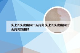 头上长头皮癣抹什么药膏 头上长头皮癣抹什么药膏效果好