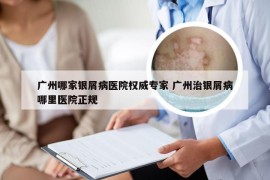 广州哪家银屑病医院权威专家 广州治银屑病哪里医院正规