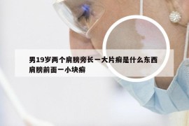 男19岁两个肩膀旁长一大片癣是什么东西 肩膀前面一小块癣