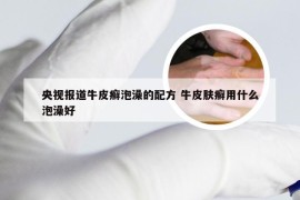 央视报道牛皮癣泡澡的配方 牛皮肤癣用什么泡澡好