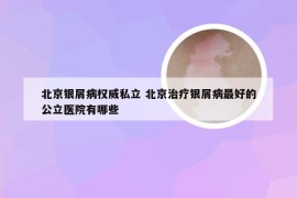 北京银屑病权威私立 北京治疗银屑病最好的公立医院有哪些