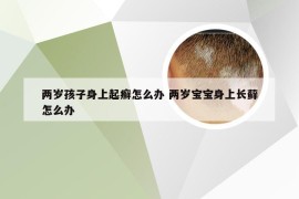 两岁孩子身上起癣怎么办 两岁宝宝身上长藓怎么办