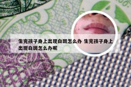 生完孩子身上出现白斑怎么办 生完孩子身上出现白斑怎么办呢