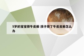 5岁的宝宝得牛皮癣 孩子得了牛皮皮癣怎么办