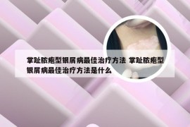 掌趾脓疱型银屑病最佳治疗方法 掌趾脓疱型银屑病最佳治疗方法是什么