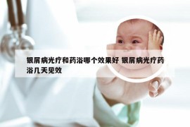 银屑病光疗和药浴哪个效果好 银屑病光疗药浴几天见效